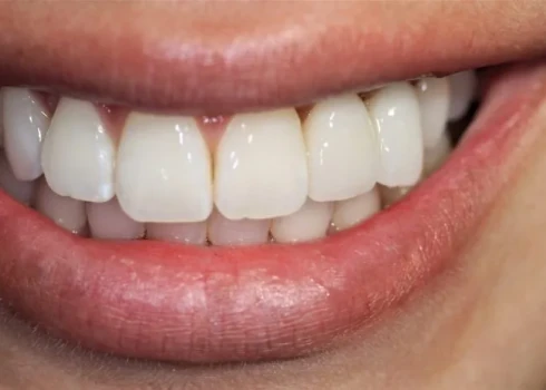 Alyssa's restored smile after her smile makeover